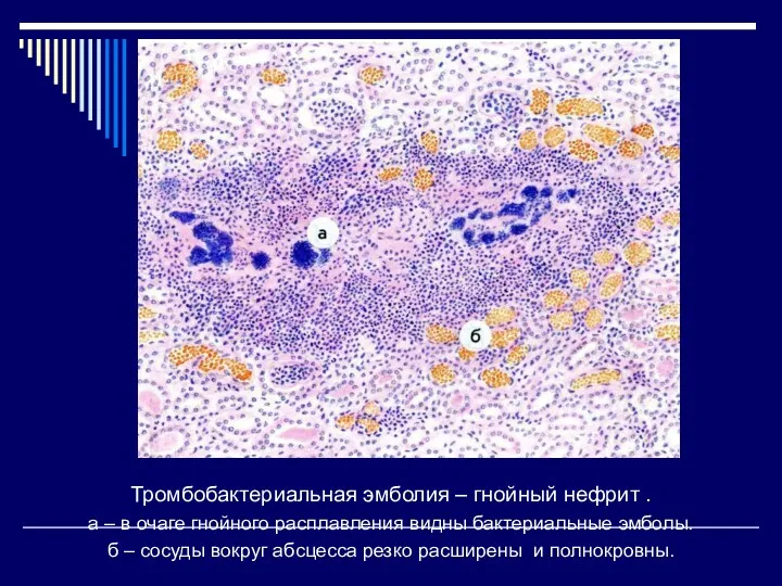 Тромбобактериальная эмболия – гнойный нефрит . а – в очаге