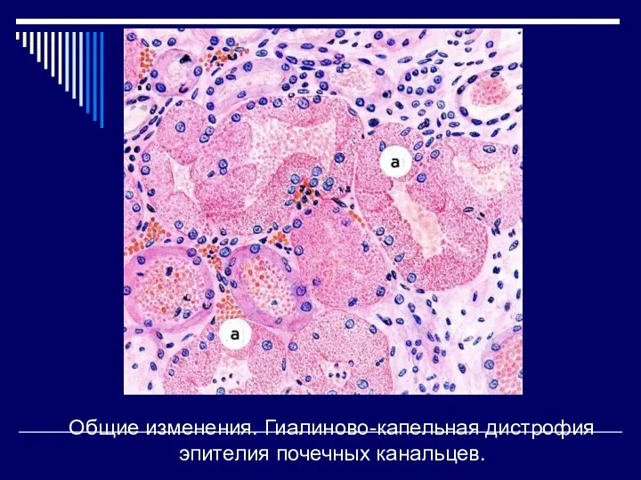 Общие изменения. Гиалиново-капельная дистрофия эпителия почечных канальцев.