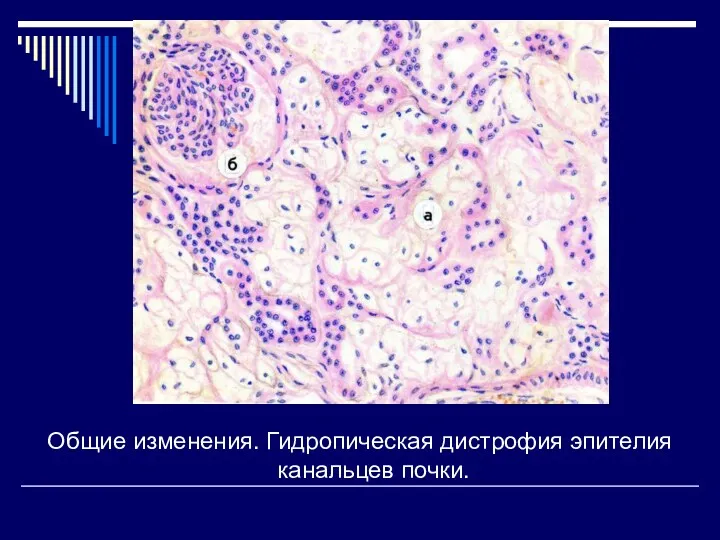 Общие изменения. Гидропическая дистрофия эпителия канальцев почки.