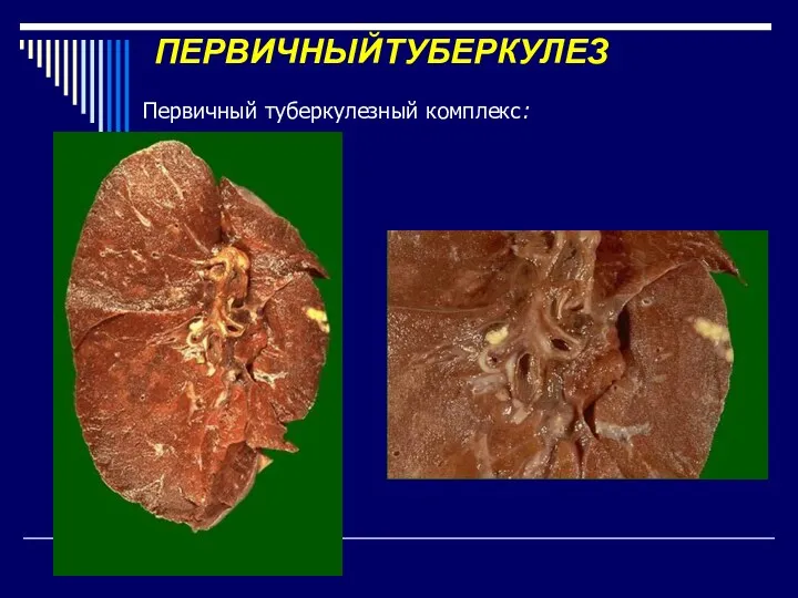 ПЕРВИЧНЫЙТУБЕРКУЛЕЗ Первичный туберкулезный комплекс: