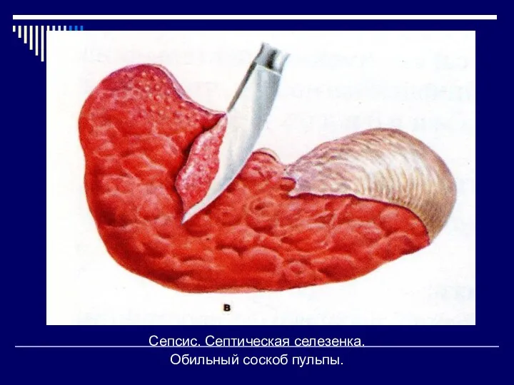 Сепсис. Септическая селезенка. Обильный соскоб пульпы.