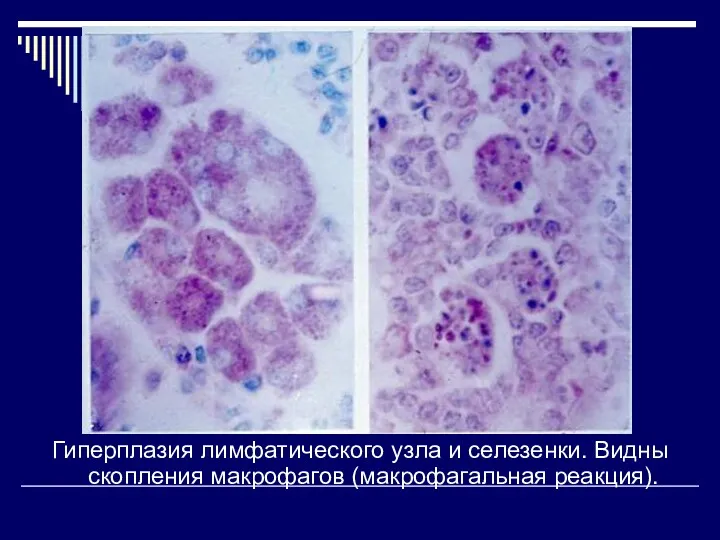 Гиперплазия лимфатического узла и селезенки. Видны скопления макрофагов (макрофагальная реакция).
