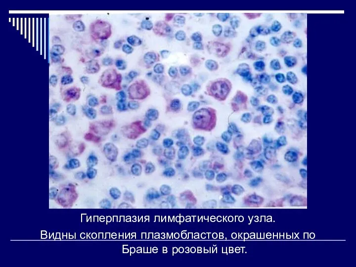 Гиперплазия лимфатического узла. Видны скопления плазмобластов, окрашенных по Браше в розовый цвет.
