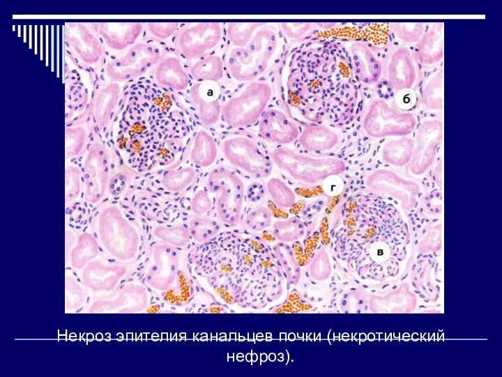 Некроз эпителия канальцев почки (некротический нефроз).