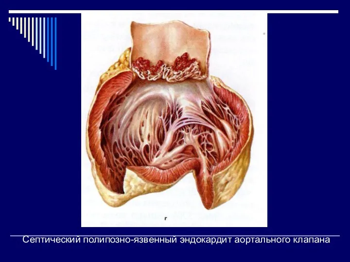 Септический полипозно-язвенный эндокардит аортального клапана