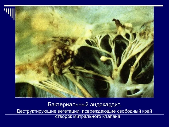 Бактериальный эндокардит. Деструктирующие вегетации, повреждающие свободный край створок митрального клапана
