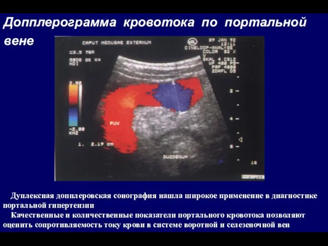 Допплерограмма кровотока по портальной вене Дуплексная допплеровская сонография нашла широкое