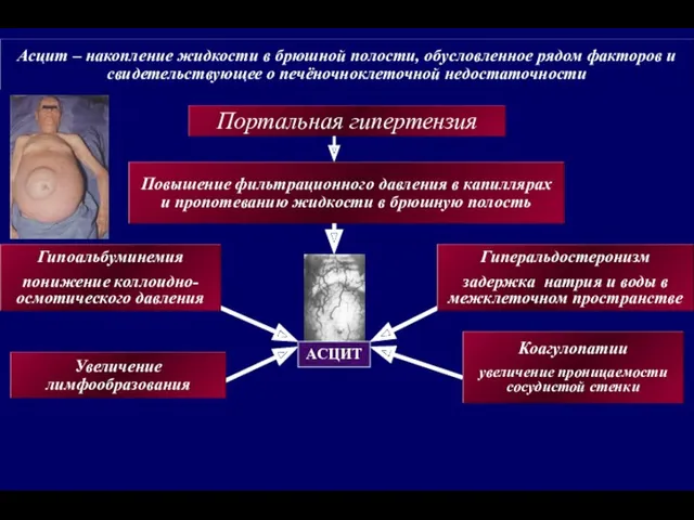 Асцит – накопление жидкости в брюшной полости, обусловленное рядом факторов