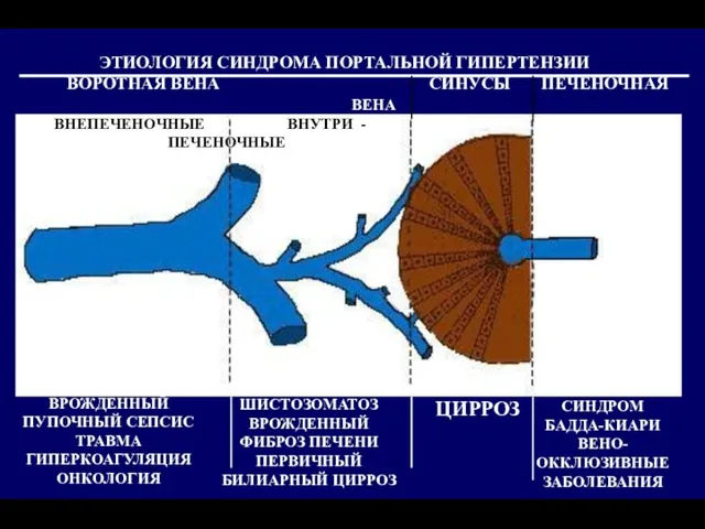 ЭТИОЛОГИЯ СИНДРОМА ПОРТАЛЬНОЙ ГИПЕРТЕНЗИИ ВОРОТНАЯ ВЕНА СИНУСЫ ПЕЧЕНОЧНАЯ ВЕНА ВНЕПЕЧЕНОЧНЫЕ