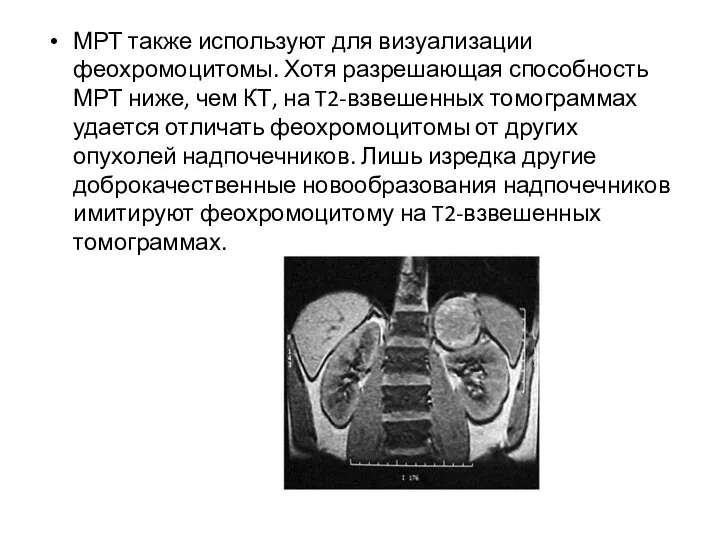 МРТ также используют для визуализации феохромоцитомы. Хотя разрешающая способность МРТ