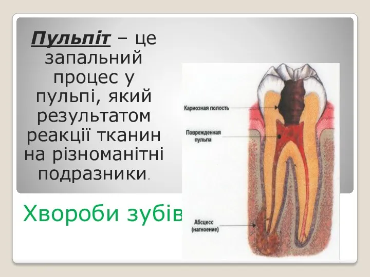 Хвороби зубів Пульпіт – це запальний процес у пульпі, який результатом реакції тканин на різноманітні подразники.