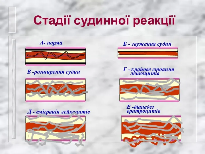 Стадії судинної реакції А- норма Б - звуження судин В