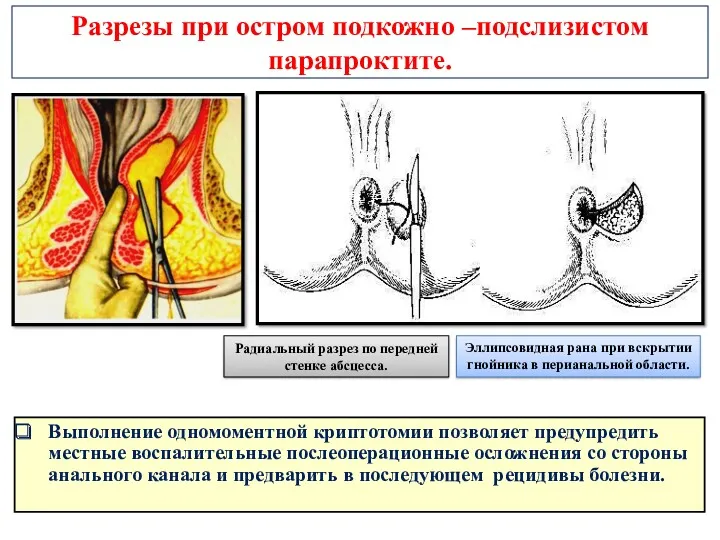 Разрезы при остром подкожно –подслизистом парапроктите. Выполнение одномоментной криптотомии позволяет