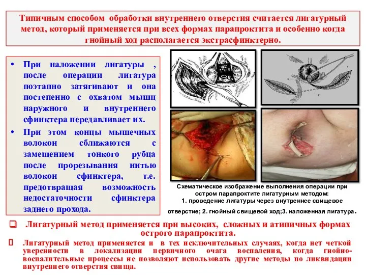 Типичным способом обработки внутреннего отверстия считается лигатурный метод, который применяется