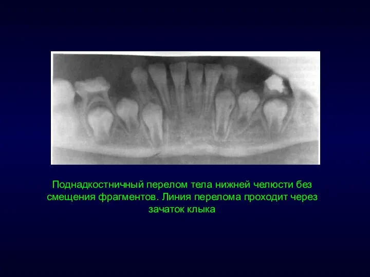 Поднадкостничный перелом тела нижней челюсти без смещения фрагментов. Линия перелома проходит через зачаток клыка