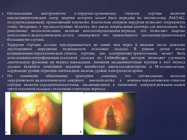 Оптимальным инструментом в хирургии хронических стенозов гортани является высокоэнергетический лазер,