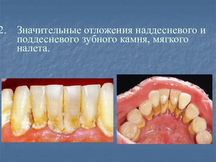Значительные отложения наддесневого и поддесневого зубного камня, мягкого налета.