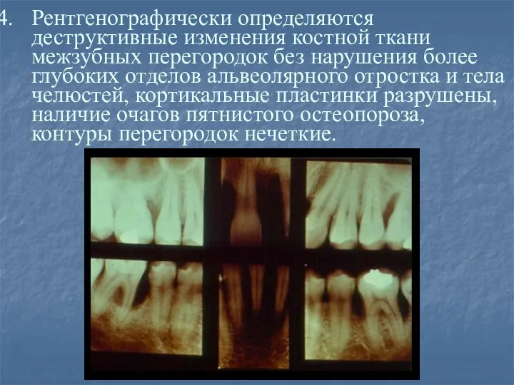 Рентгенографически определяются деструктивные изменения костной ткани межзубных перегородок без нарушения