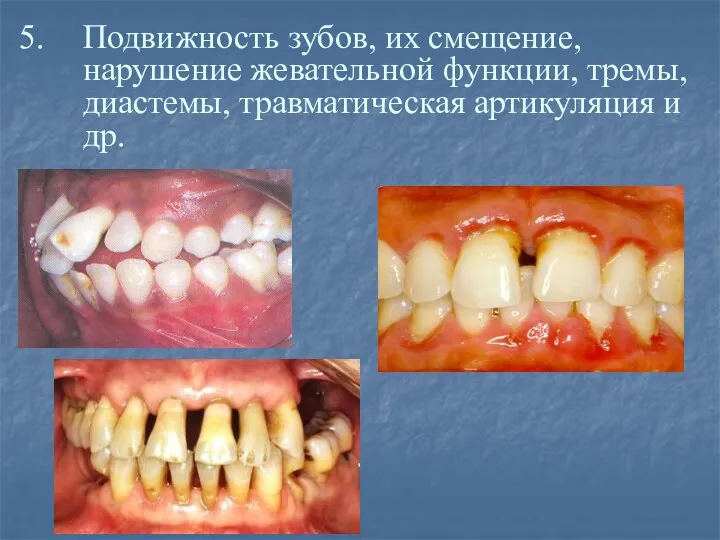 Подвижность зубов, их смещение, нарушение жевательной функции, тремы, диастемы, травматическая артикуляция и др.