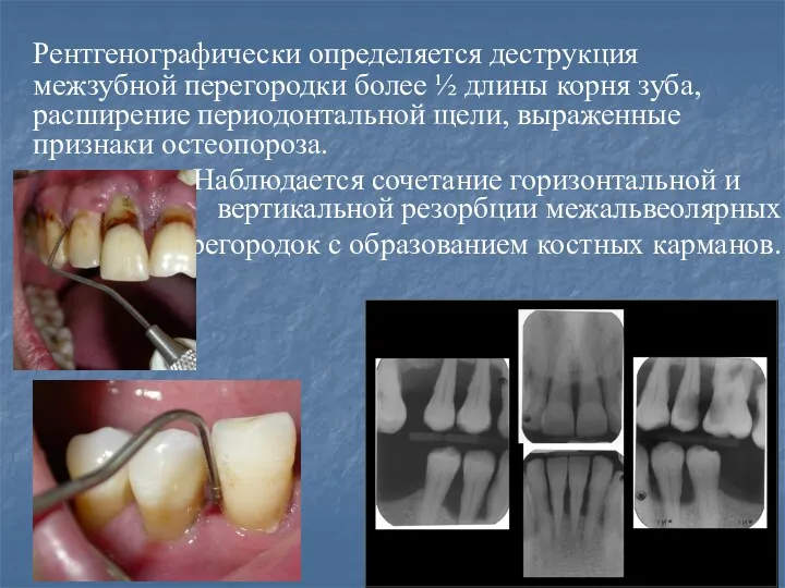 Рентгенографически определяется деструкция межзубной перегородки более ½ длины корня зуба,