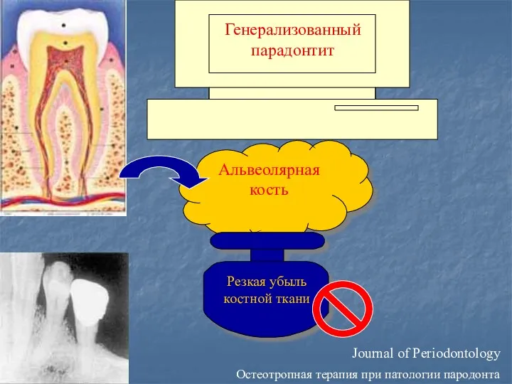 Journal of Periodontology Остеотропная терапия при патологии пародонта