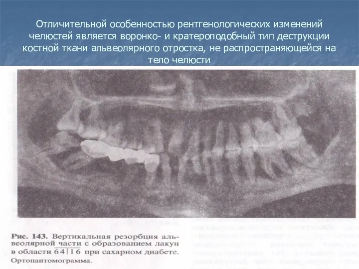 Отличительной особенностью рентгенологических изменений челюстей является воронко- и кратероподобный тип
