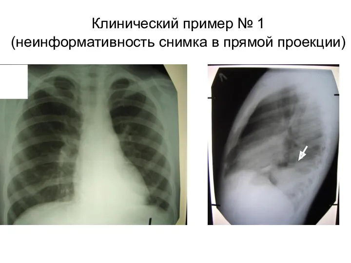 Клинический пример № 1 (неинформативность снимка в прямой проекции)