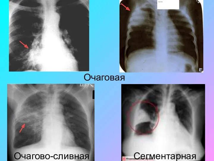 Очаговая Очагово-сливная Сегментарная