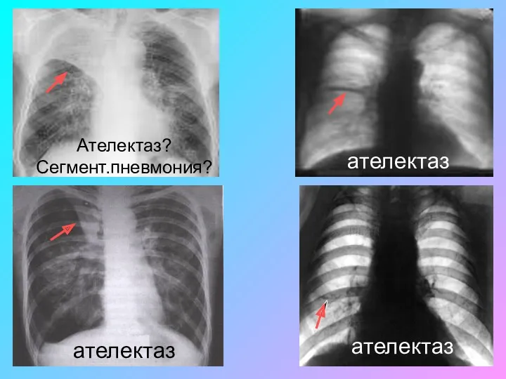 ателектаз ателектаз ателектаз Ателектаз? Сегмент.пневмония?