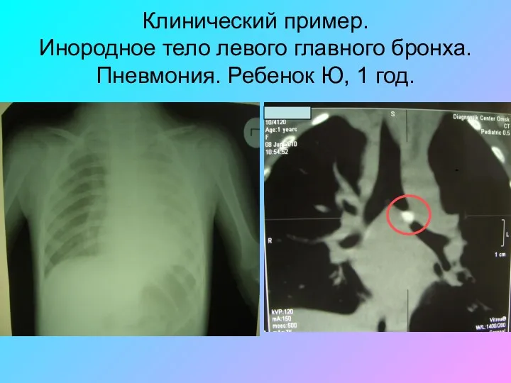 Клинический пример. Инородное тело левого главного бронха. Пневмония. Ребенок Ю, 1 год.