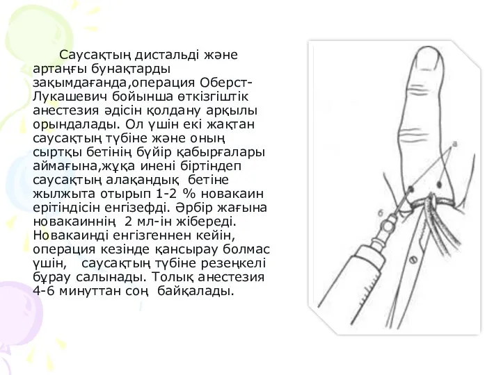 Саусақтың дистальді және артаңғы бунақтарды зақымдағанда,операция Оберст-Лукашевич бойынша өткізгіштік анестезия әдісін қолдану арқылы