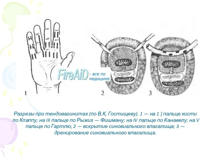 Разрезы при тендовагинитах (по В.К, Гостищеву). 1 — на 1 ] пальце кисти