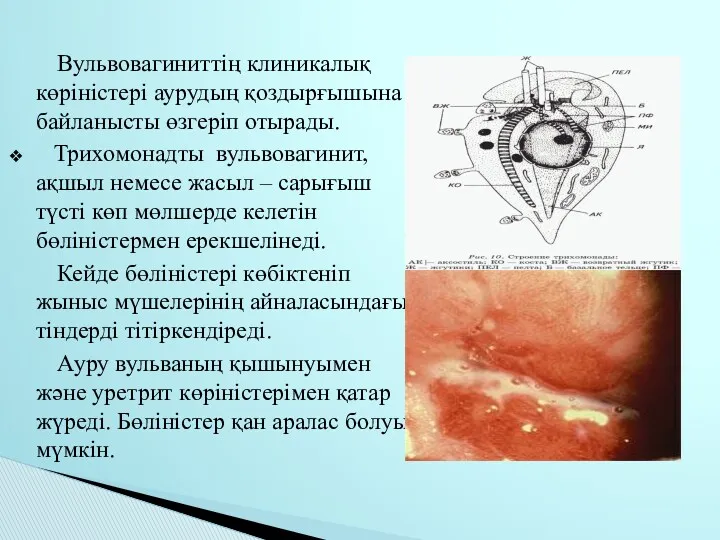 Вульвовагиниттің клиникалық көріністері аурудың қоздырғышына байланысты өзгеріп отырады. Трихомонадты вульвовагинит,