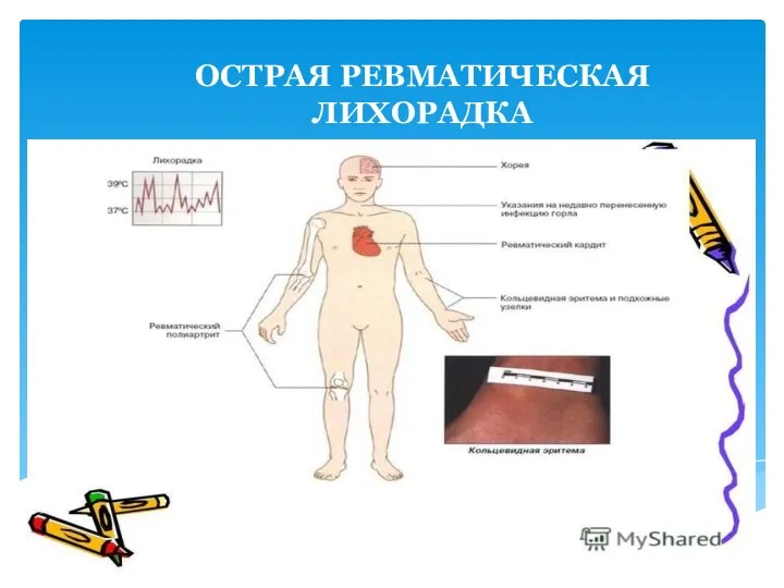 ОСТРАЯ РЕВМАТИЧЕСКАЯ ЛИХОРАДКА