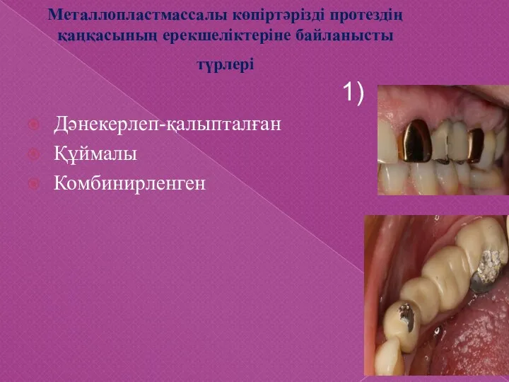 Металлопластмассалы көпіртәрізді протездің қаңқасының ерекшеліктеріне байланысты түрлері 1) Дәнекерлеп-қалыпталған Құймалы Комбинирленген 2)