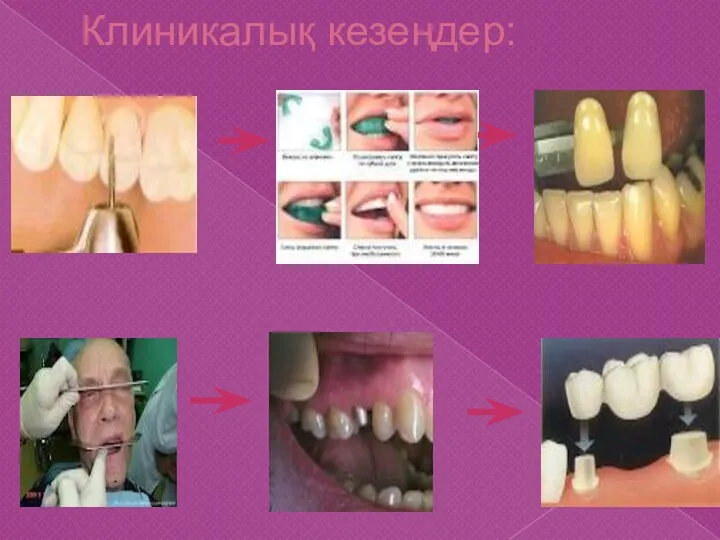 Клиникалық кезеңдер: