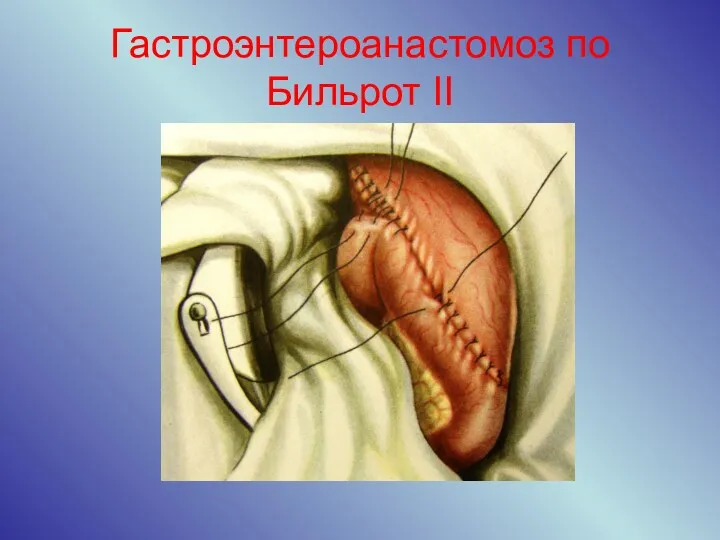 Гастроэнтероанастомоз по Бильрот II