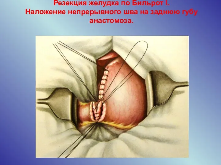 Резекция желудка по Бильрот I. Наложение непрерывного шва на заднюю губу анастомоза.