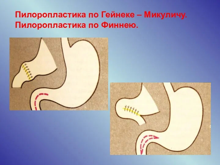 Пилоропластика по Гейнеке – Микуличу. Пилоропластика по Финнею.