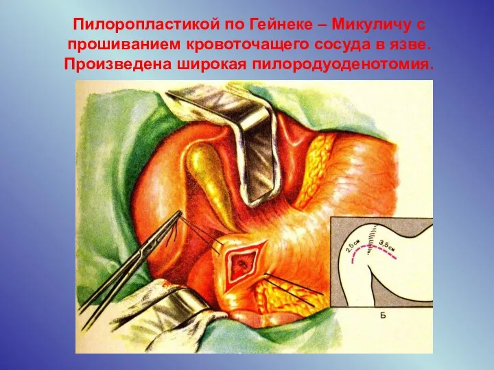 Пилоропластикой по Гейнеке – Микуличу с прошиванием кровоточащего сосуда в язве. Произведена широкая пилородуоденотомия.