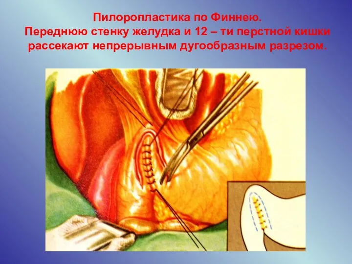 Пилоропластика по Финнею. Переднюю стенку желудка и 12 – ти перстной кишки рассекают непрерывным дугообразным разрезом.