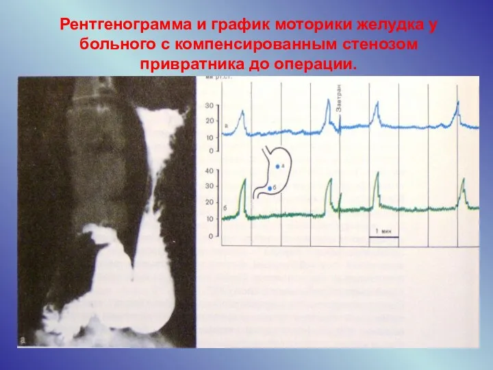 Рентгенограмма и график моторики желудка у больного с компенсированным стенозом привратника до операции.