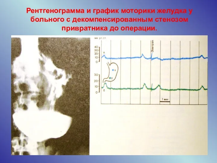 Рентгенограмма и график моторики желудка у больного с декомпенсированным стенозом привратника до операции.