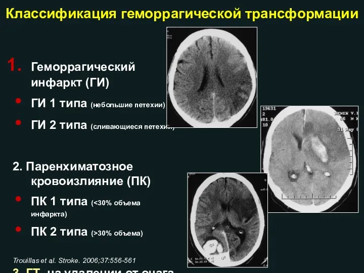 Классификация геморрагической трансформации Геморрагический инфаркт (ГИ) ГИ 1 типа (небольшие