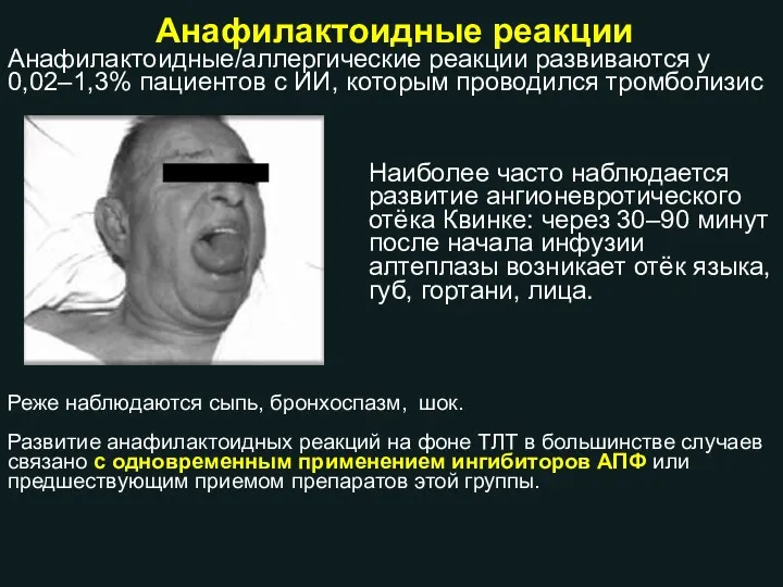 Наиболее часто наблюдается развитие ангионевротического отёка Квинке: через 30–90 минут