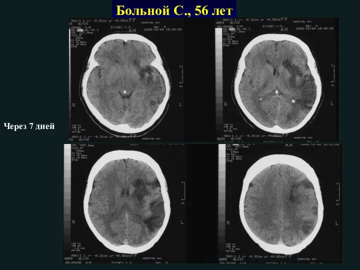 Через 7 дней Больной С., 56 лет