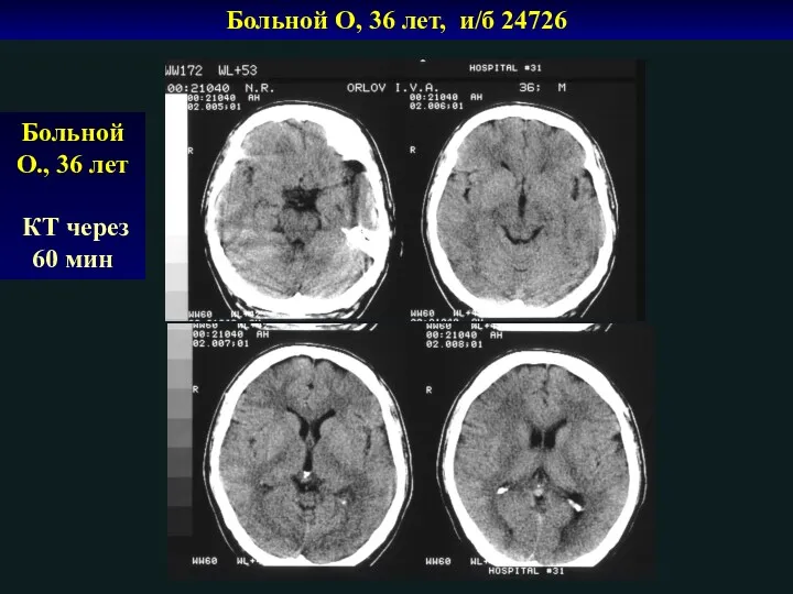 Больной О, 36 лет, и/б 24726 Больной О., 36 лет КТ через 60 мин