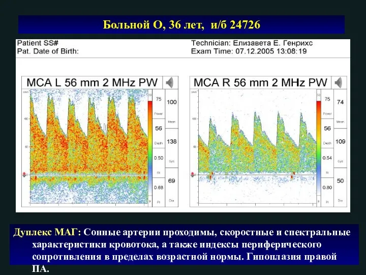 Больной О, 36 лет, и/б 24726 Дуплекс МАГ: Сонные артерии проходимы, скоростные и