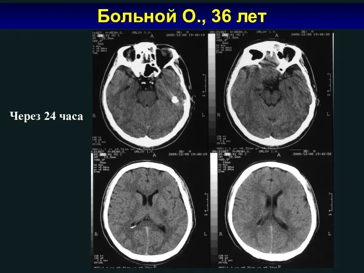 Больной О., 36 лет Через 24 часа