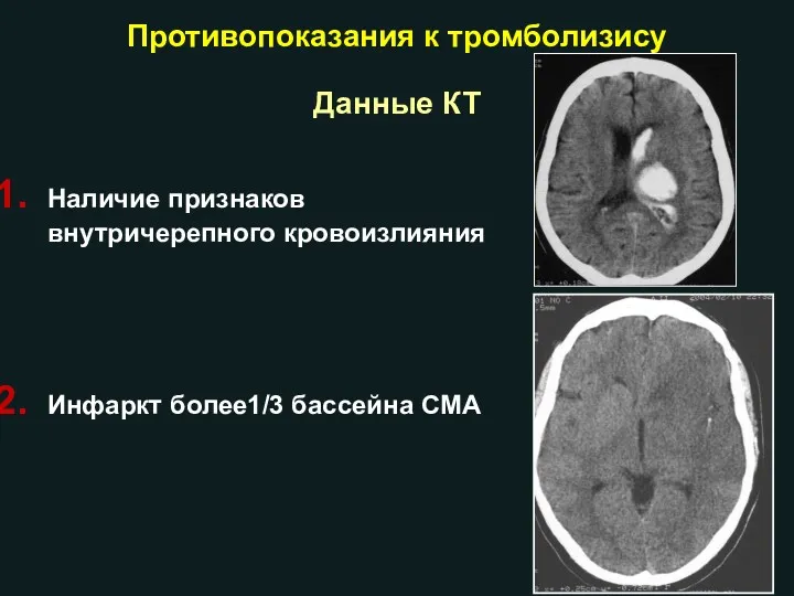 Данные КТ Наличие признаков внутричерепного кровоизлияния Инфаркт более1/3 бассейна СМА Противопоказания к тромболизису